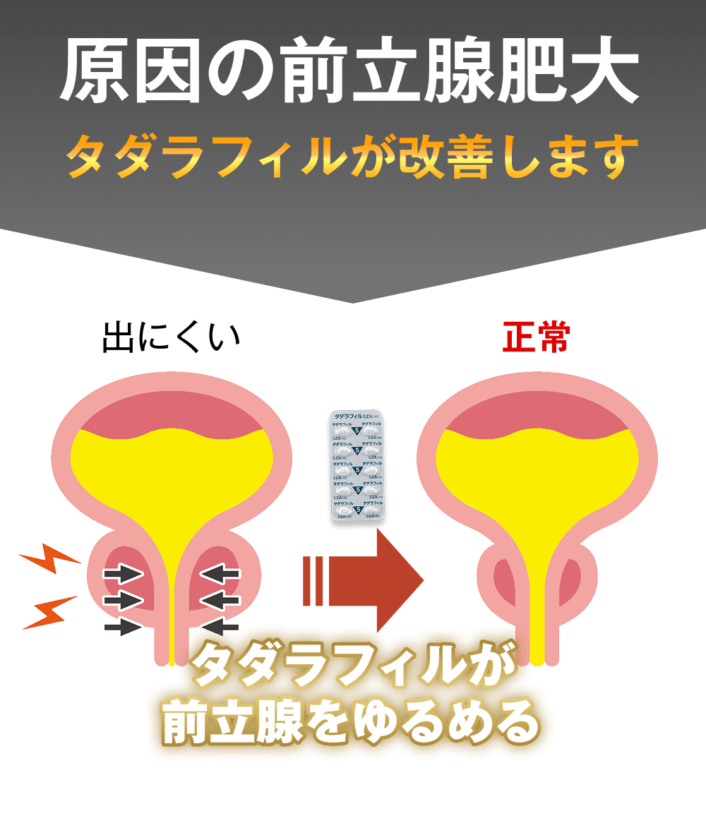 タダラフィルが前立腺肥大を改善する図