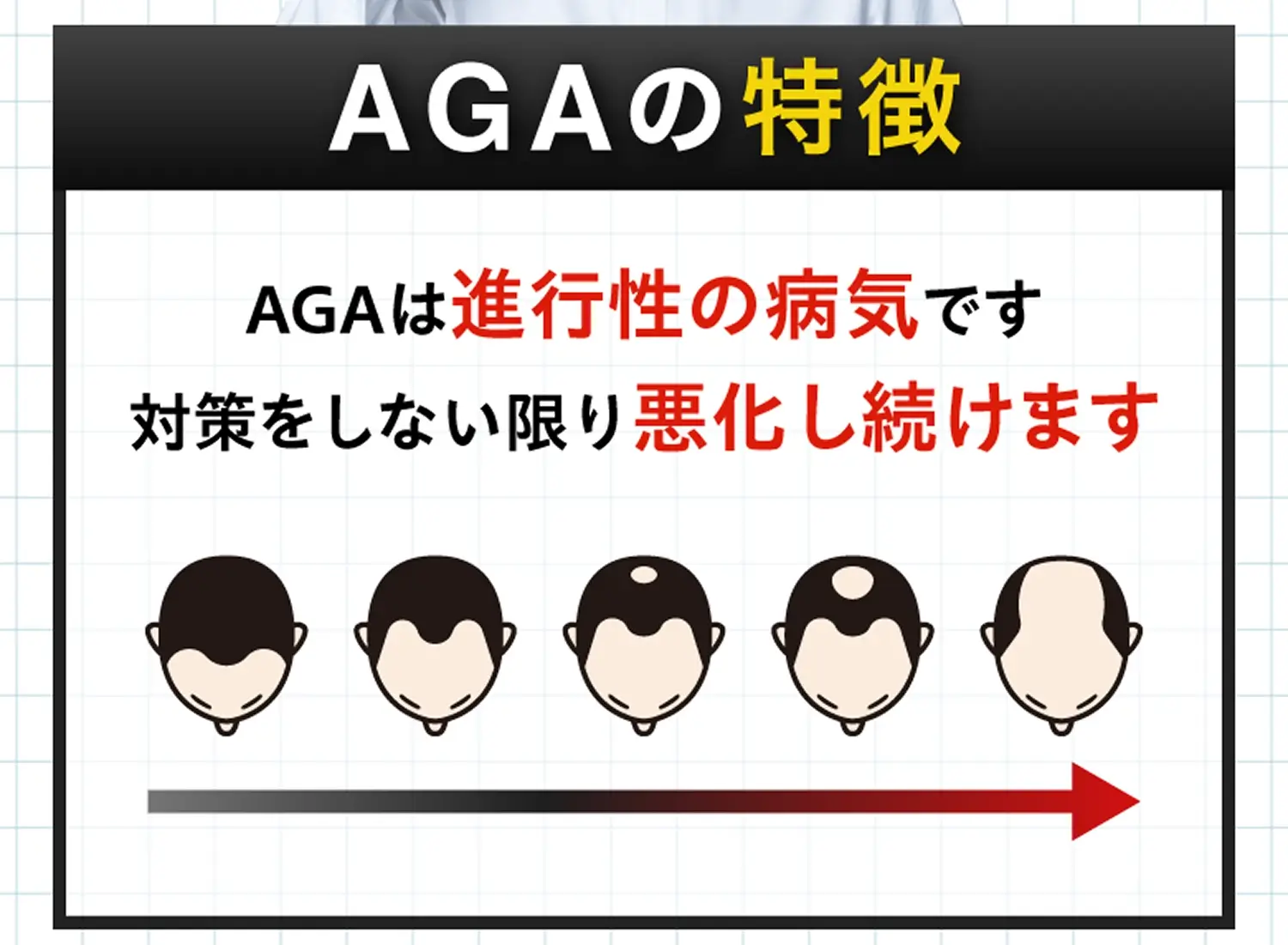 AGAの特徴