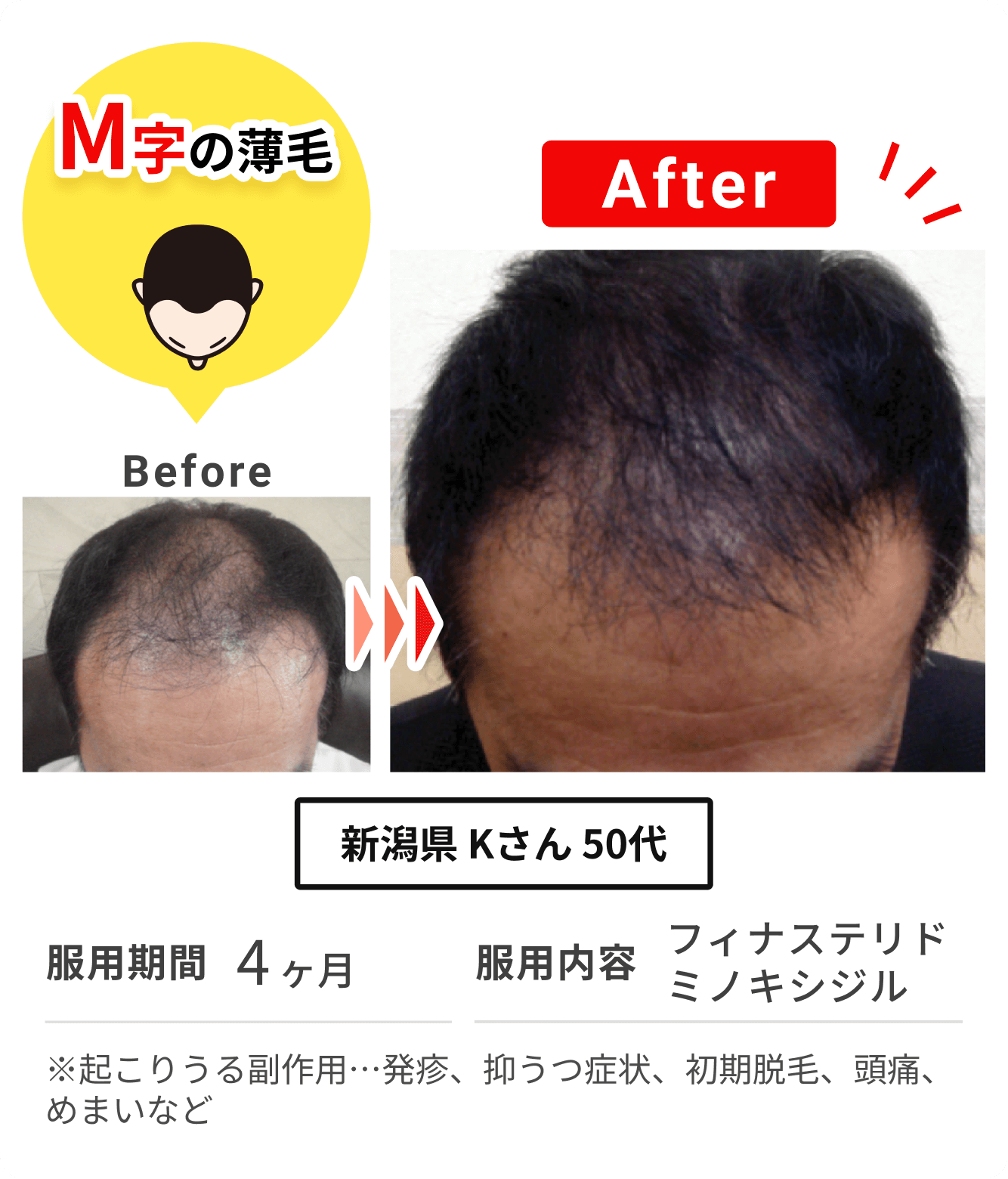 新潟県 Kさん 50代 の症例