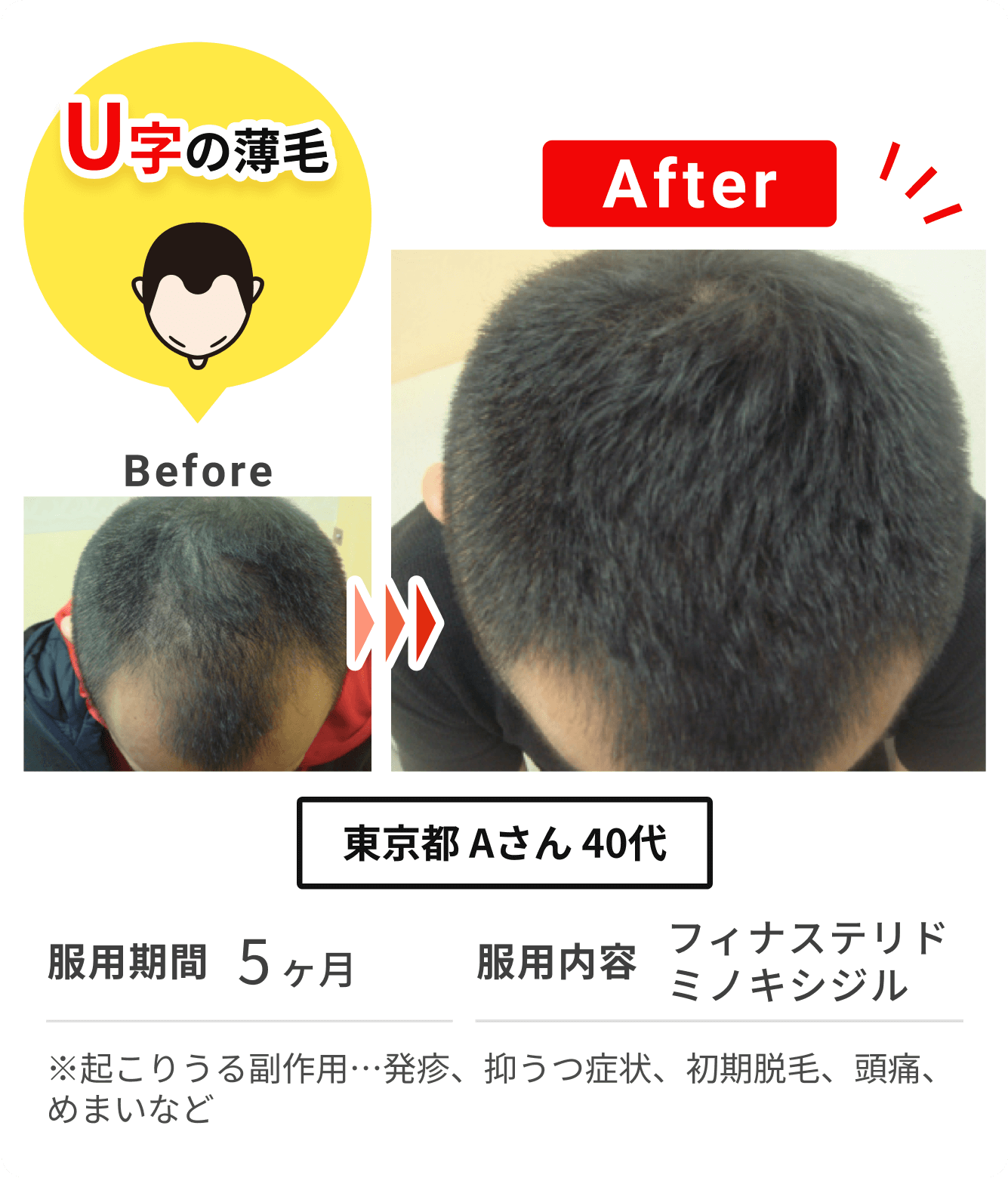 東京都 Aさん 40代 の症例