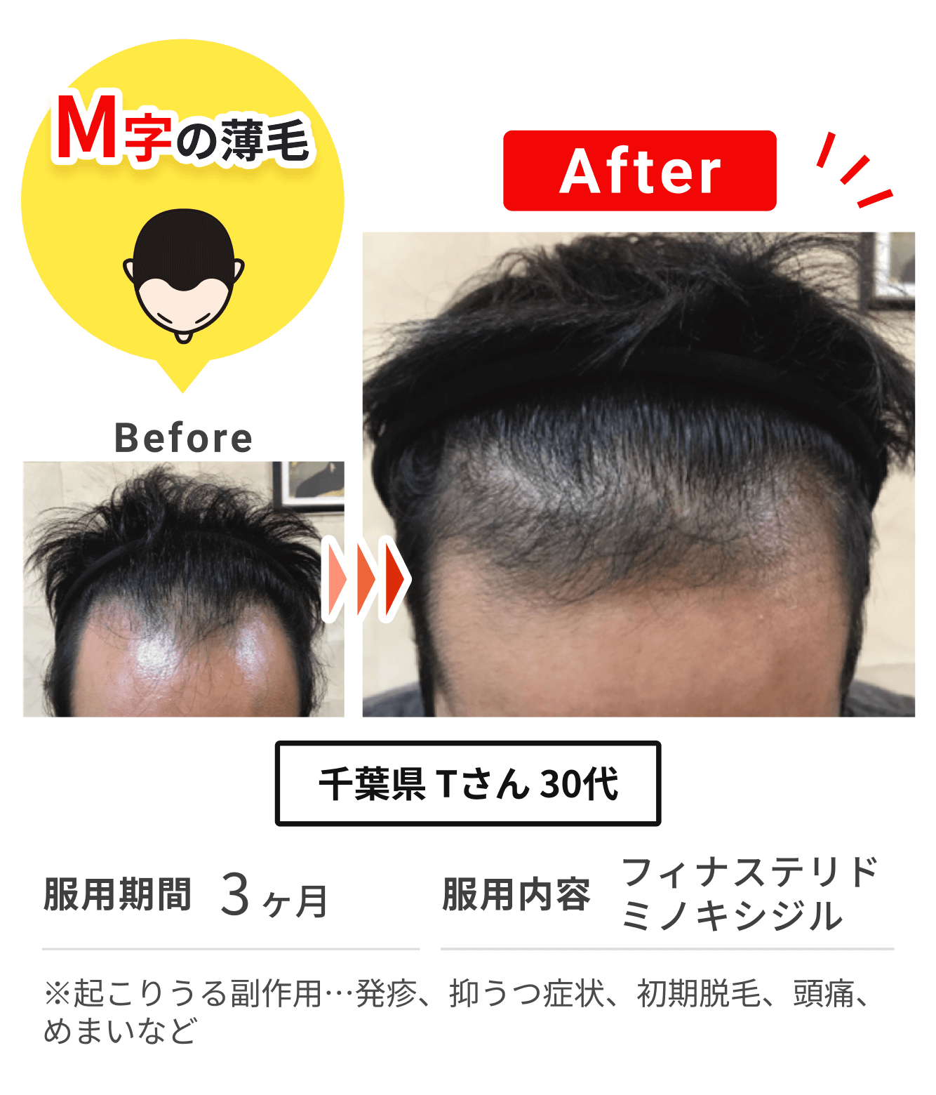 千葉県 Tさん 30代 の症例