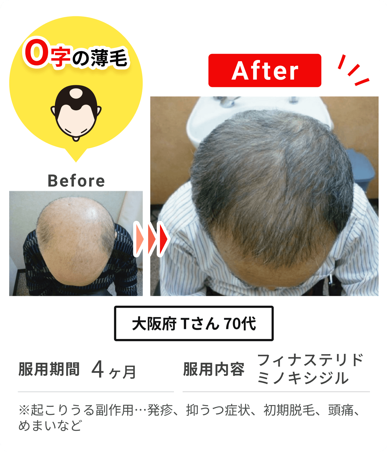 大阪府 Tさん 70代 の症例