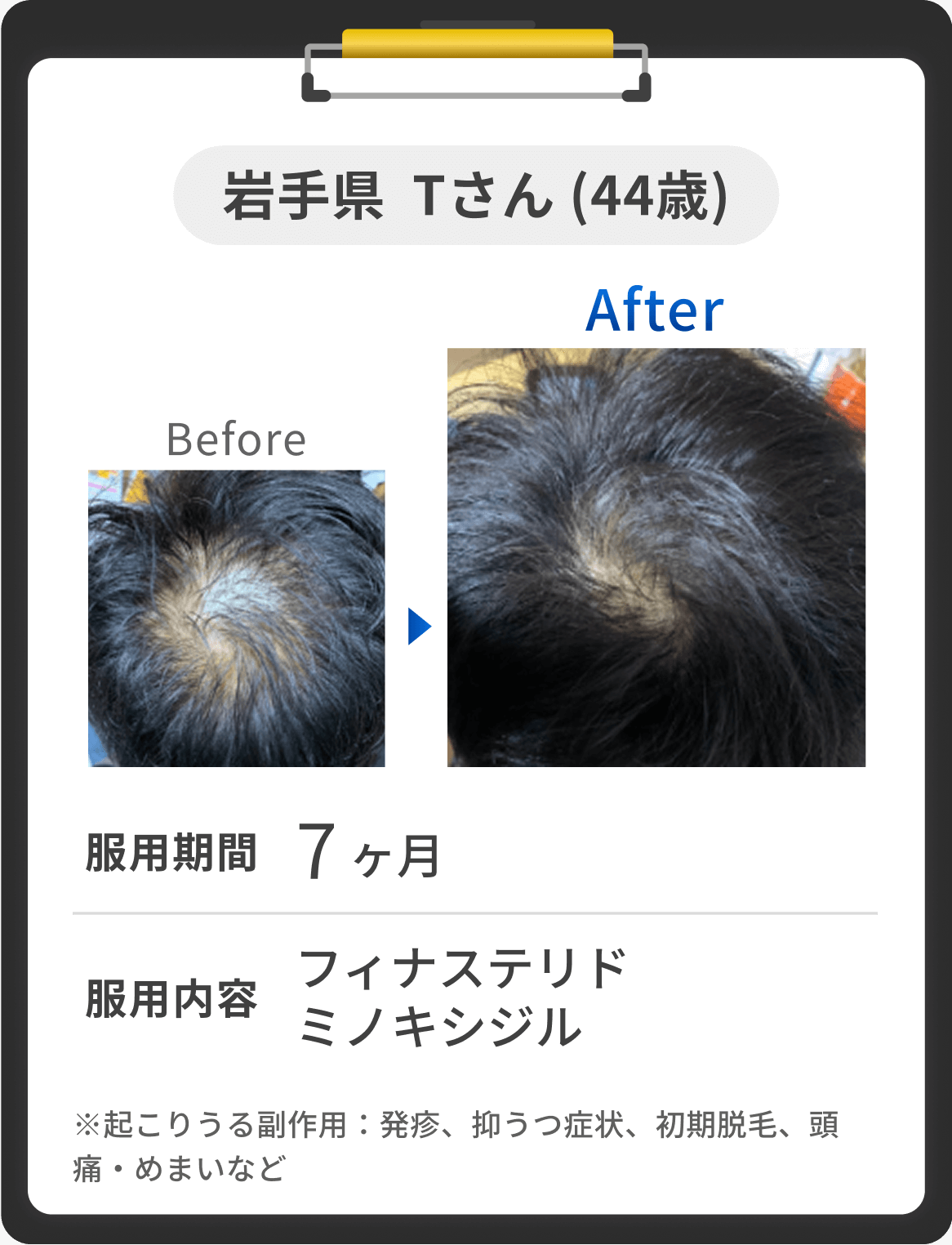 岩手県 Tさん 44歳 の症例